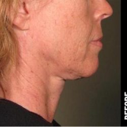 Ultherapy Before & After Patient #1557
